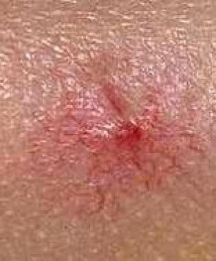 Rimozione trattamento angioma spider angioma stellare Trattamento LASER. Unica seduta - Centro Laser Chirurgia Toscana