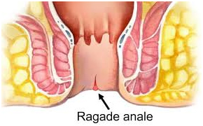 Ragadi anali Il trattamento LASER delle RAGADI anali esterne - Centro Laser Chirurgia Toscana