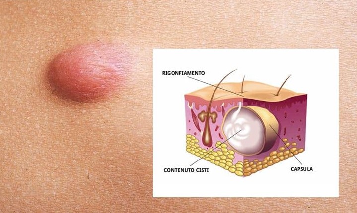 <strong>Estate a rischio per le cisti sebacee?</strong>