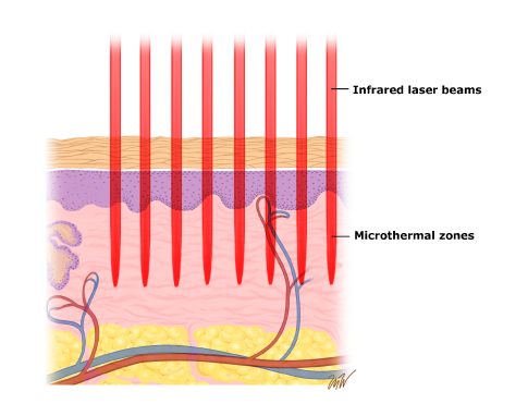 Nel disegno si visualizza l'effetto dei raggi del LASER CO2 frazionato
