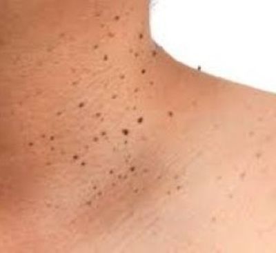 Cosa sono e come si trattano i fibromi penduli